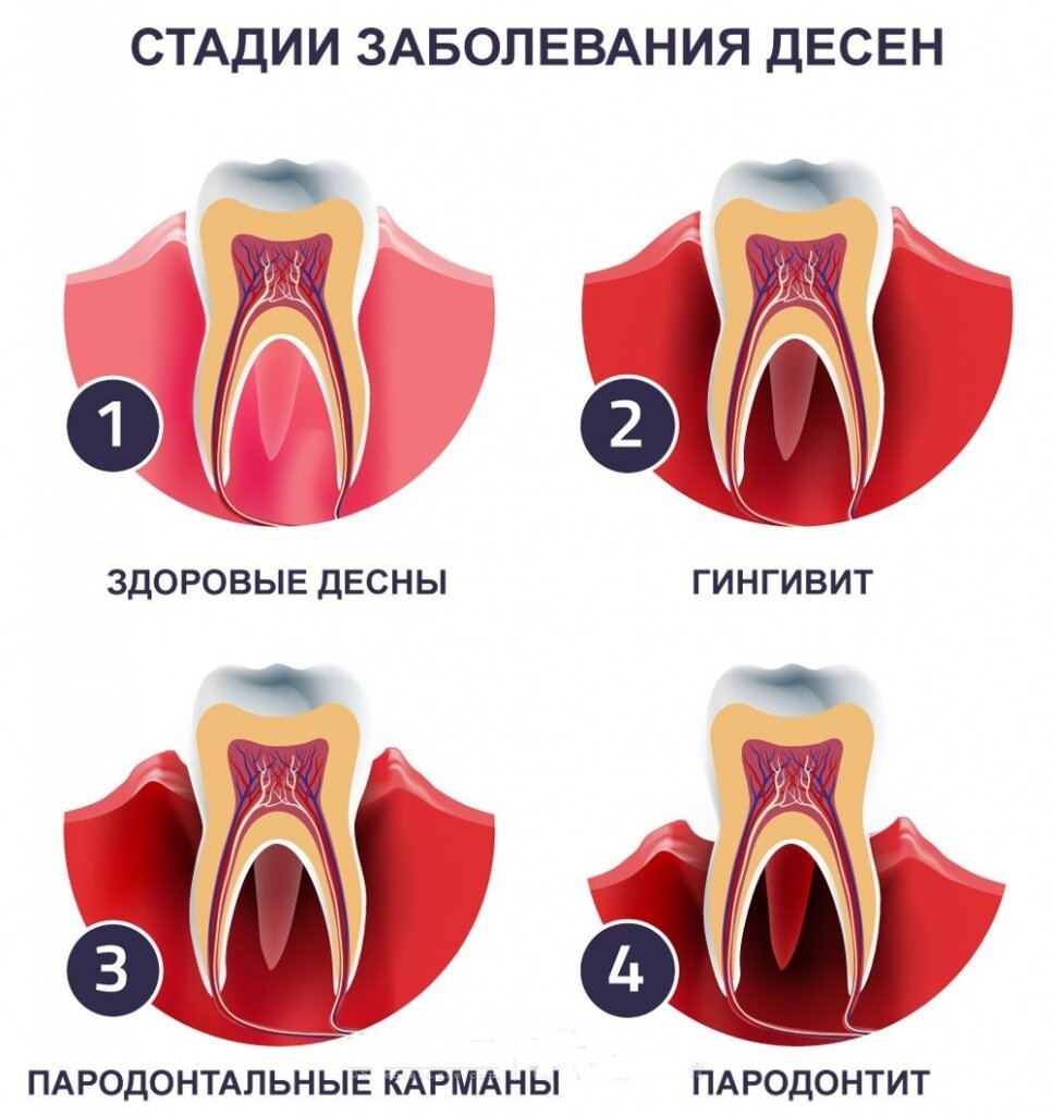 Чешутся десны у взрослого: что делать?