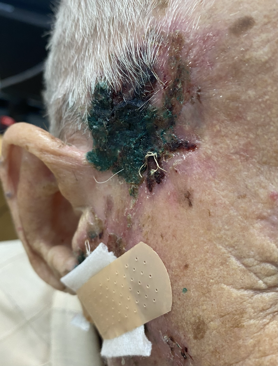 множественное поражение кожи