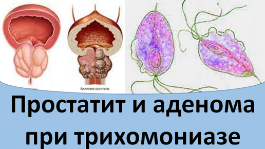 Аденома простаты карта вызова