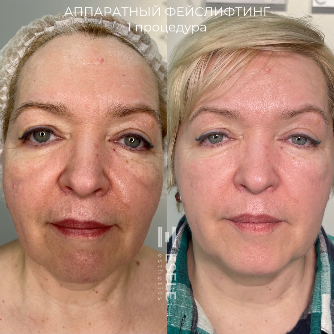 Аппаратный фейслифтинг без инъекций и операций помогает подтянуть овал лица и сделать контуры выразительнее. Фото © Центра эстетики и косметологии ESELE