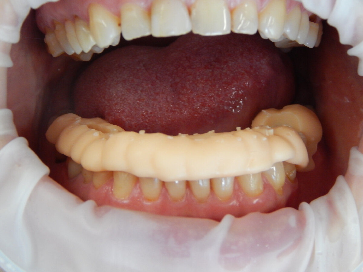 Шаблон фиксирован на зубах 