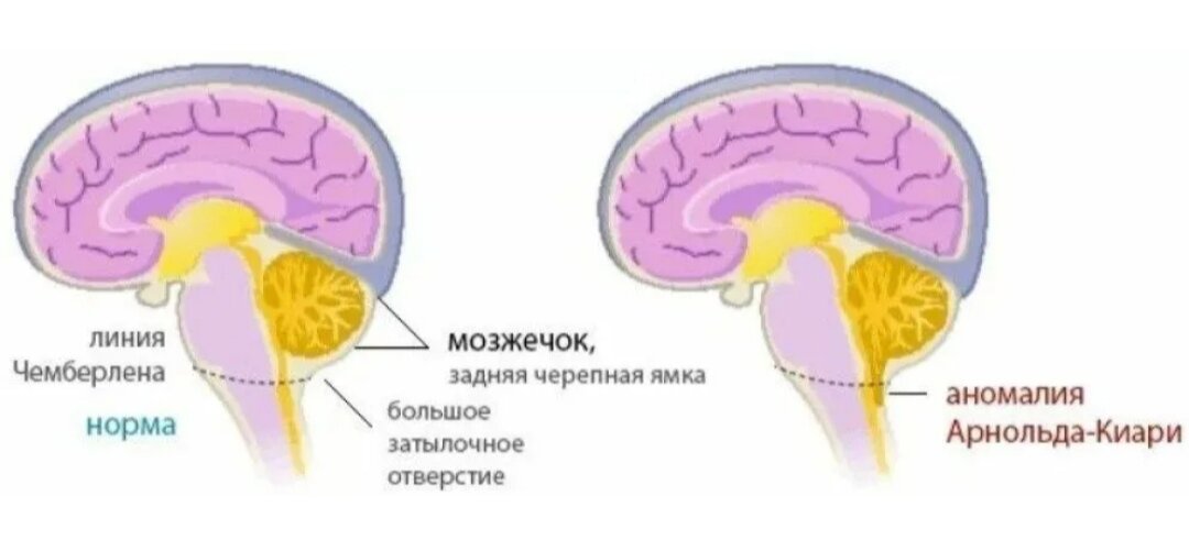 Мальформация арнольда киари. Мальформация Арнольда-Киари 1 типа. Мальформация Арнольда-Киари 2 типа. Арнольда-Киари 1 типа симптомы. Мальформация Киари 1 и 2 типа.