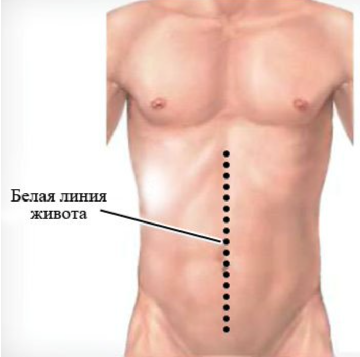 Грыжа прямой мышцы. Надчревная эпигастральная грыжа. Грыжа белой линии живота.