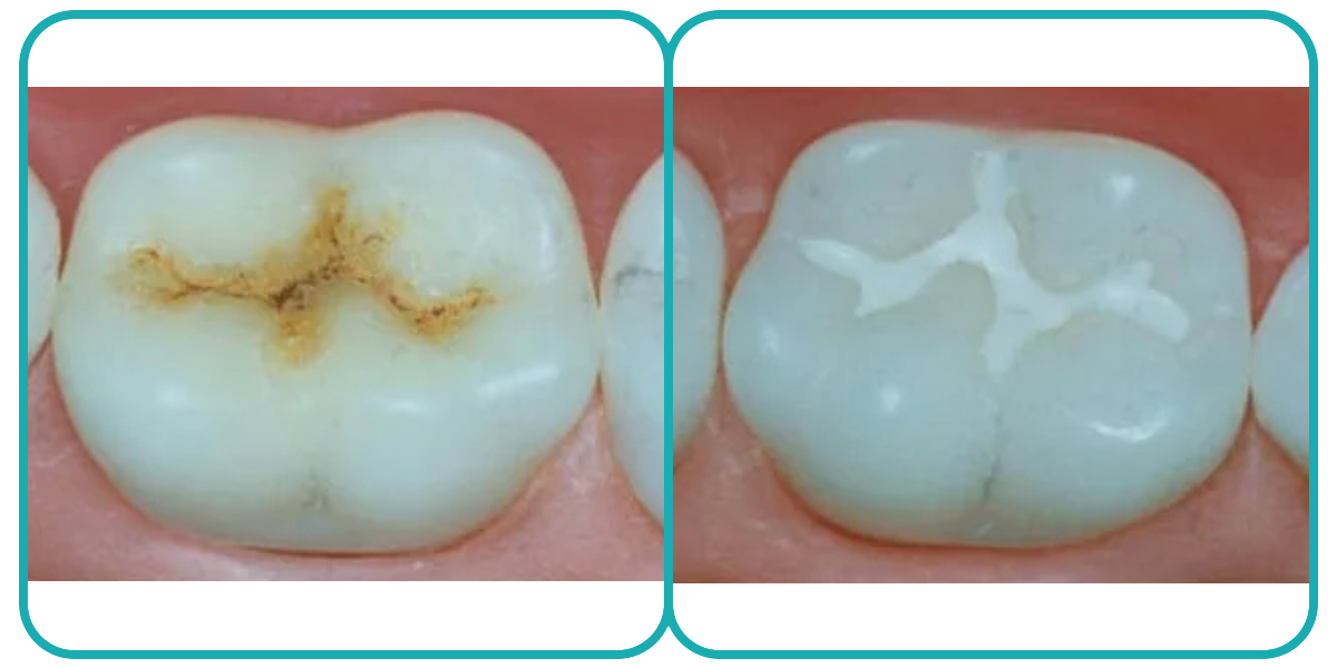 1. Пигментированная фиссура
2. Фиссура после герметизации