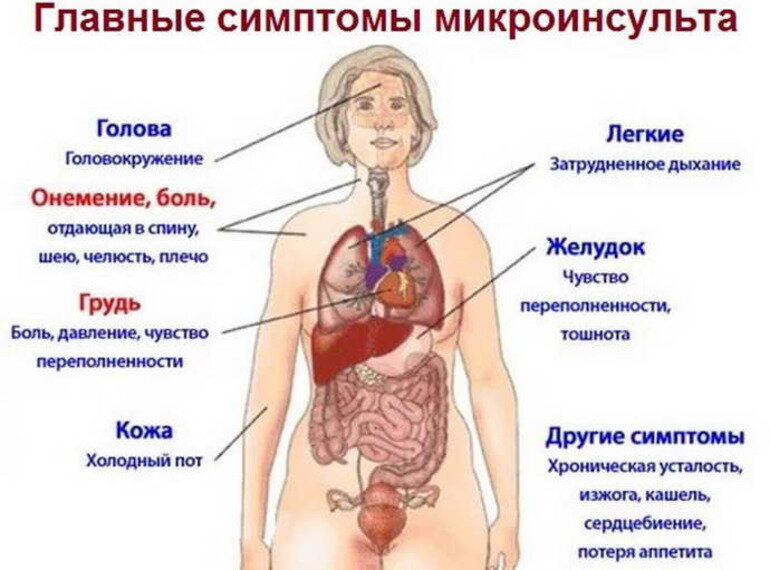 Инсульт – это резкое нарушение мозгового кровообращения. По МКБ 11 состояние получило код 8B20. Сопровождается неврологической симптоматикой.-5