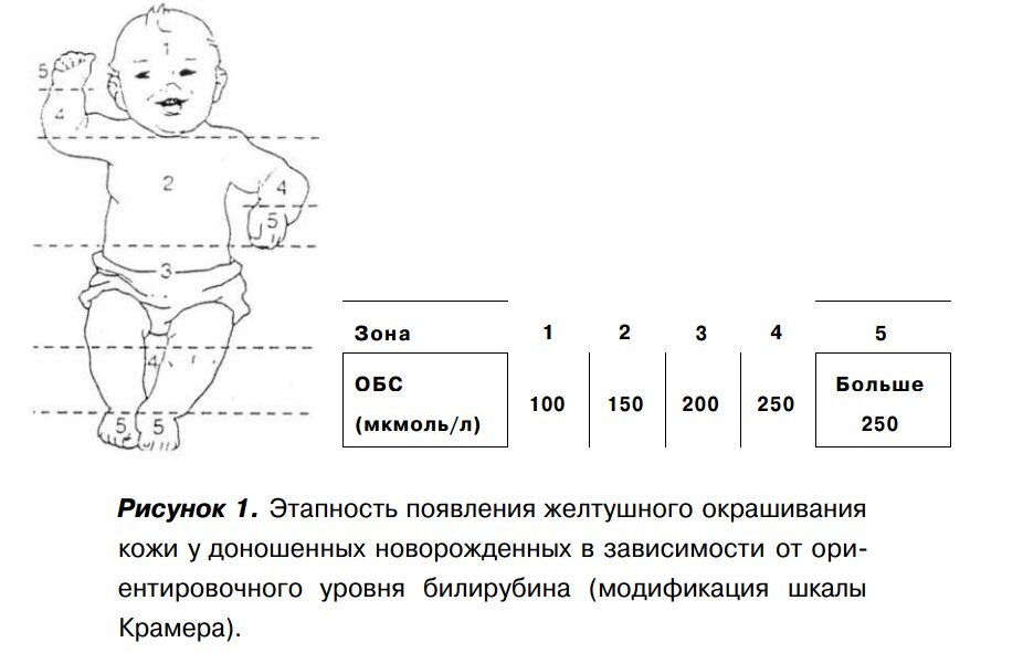 Что такое желтуха у новорожденных