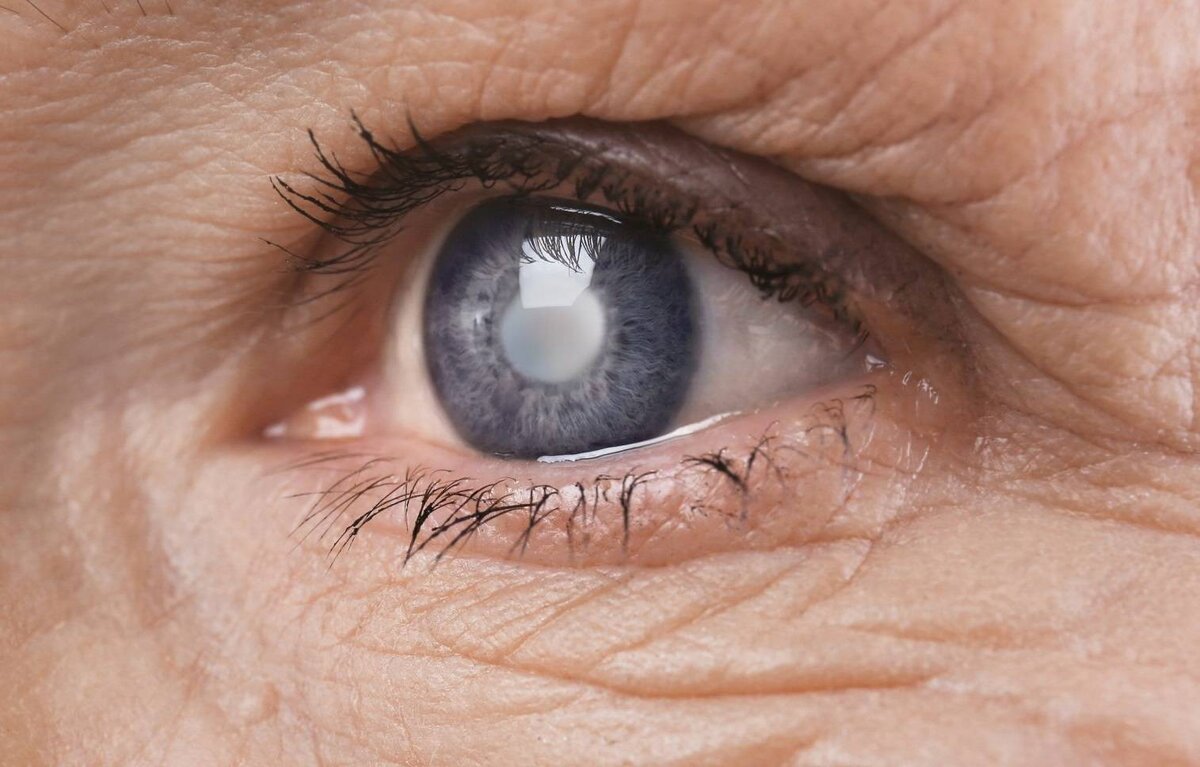 Возможно ли лечение катаракты без операции?