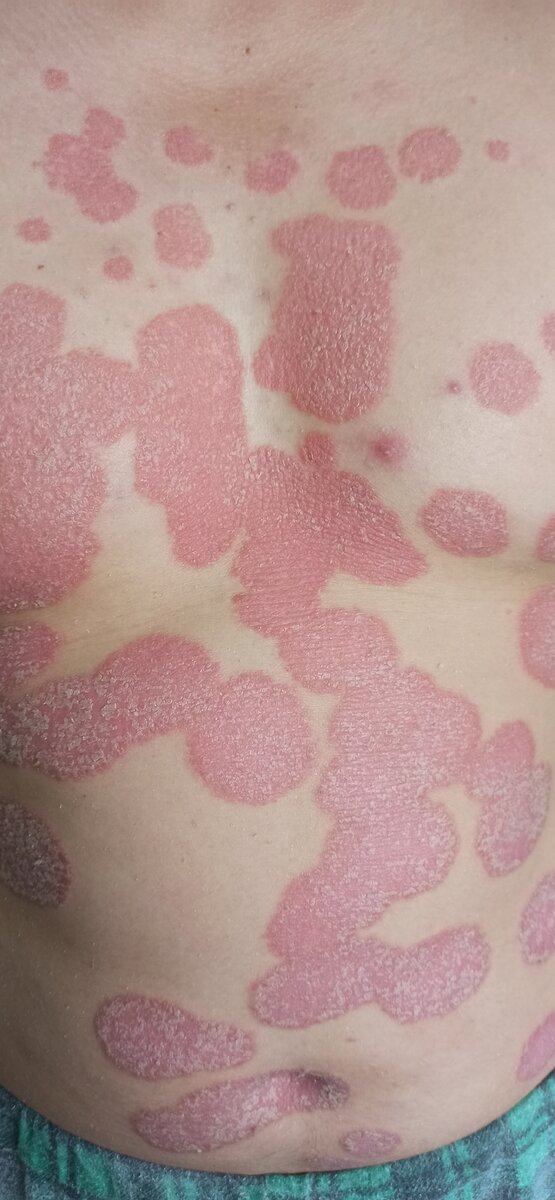 Псориаз. Мужчина 26 лет. Болеет 3 года. 