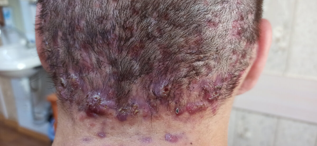 Мужчина, 19 лет. Болеет 5 месяцев