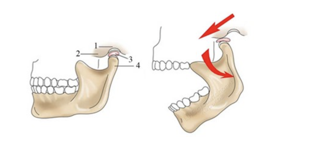 Мыщелок челюсти. Движение суставной головки ВНЧС. Нижнечелюстной подвывих челюсти.