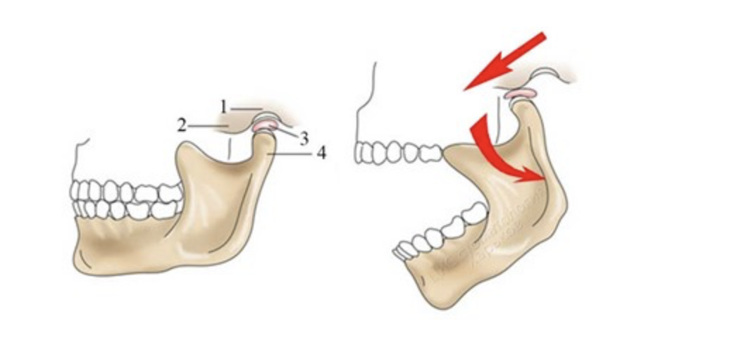 Движение суставной головки ВНЧС. Нижнечелюстной подвывих челюсти.