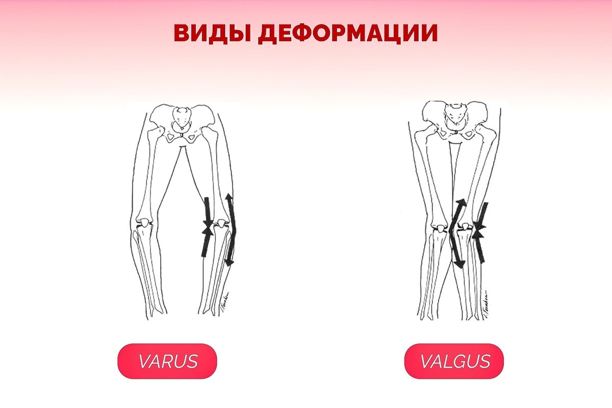 Варусная деформация коленных суставов у взрослых. Варусная деформация коленных. Варусная деформация коленных суставов. Варусная деформация коленных суставов рентген. Варусной деформации коленных суставов.