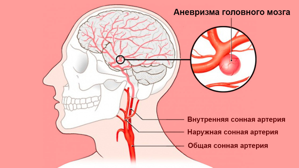 Аневризма в сосудах головного мозга – бомба замедленного действия: чем это  опасно | О здоровье: с медицинского на русский | Дзен