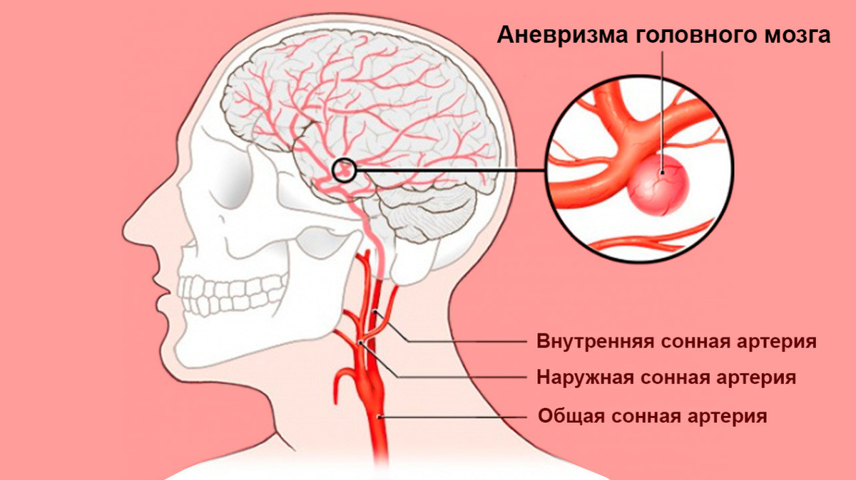 Расширение сосудов головы