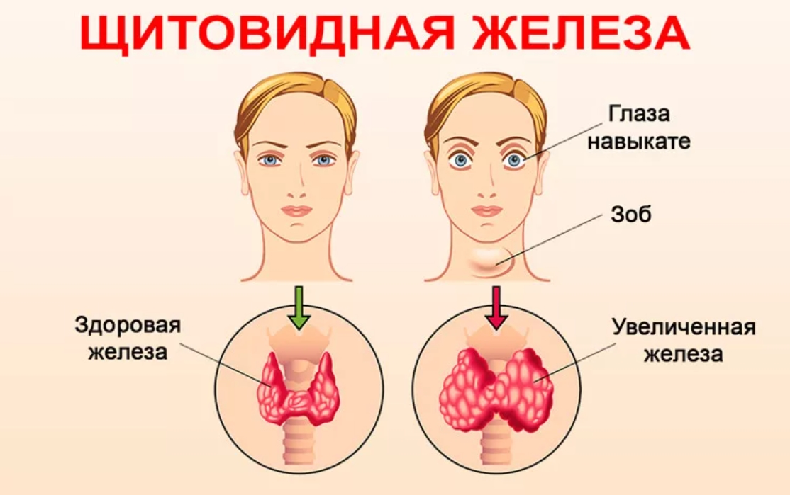 Какие симптомы заболевания щитовидной. Заболевания щитовидной железы. Заболевание щитовиднойжелезв. Щитовидная железа симптомы заболевания. Признаки больной щитовидки.