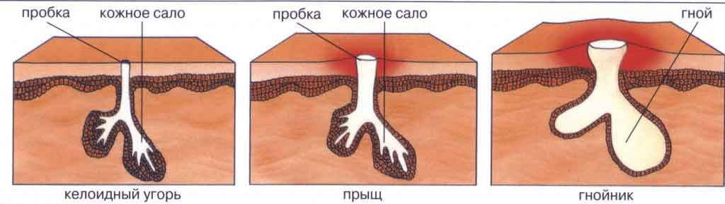Чтобы кожное сало не могло закупоривать железы, избыток жира должен быть устранен. Таким образом, если ваши прыщи не так уж плохи, достаточно часто чистить и дезинфицировать - например, с мягкими моющими кремами или гелями, которые вытягивают лишний ей