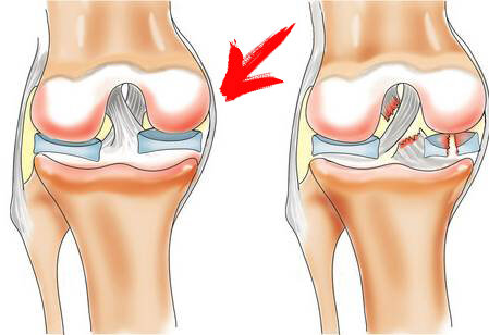 артрит, артроз, лечение, боли в суставах, признаки, симптомы