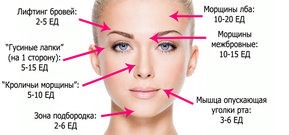 Ботокс со скольки лет. Ботокс для лица схема уколов. Схема введения диспорта в лоб. Ботокс в межбровье схема. Сколько единиц ботокса нужно для лба.