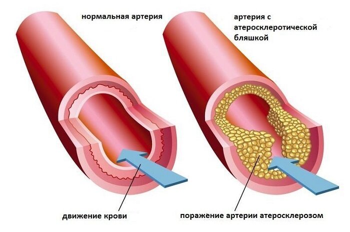         Слева здоровый сосуд, а справа закупоренный... Чем это грозит, думайте сами!