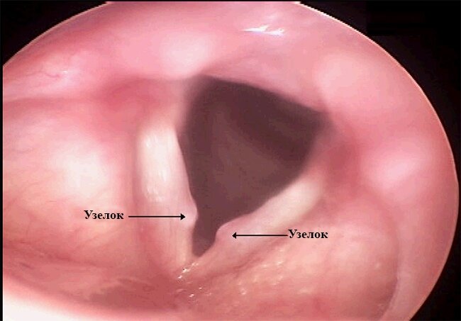 Как выглядят узелки на голосовых связках