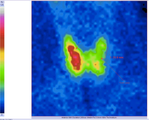 Когда нужна Сцинтиграфия щитовидной железы? | Клиника щитовидной железы ...