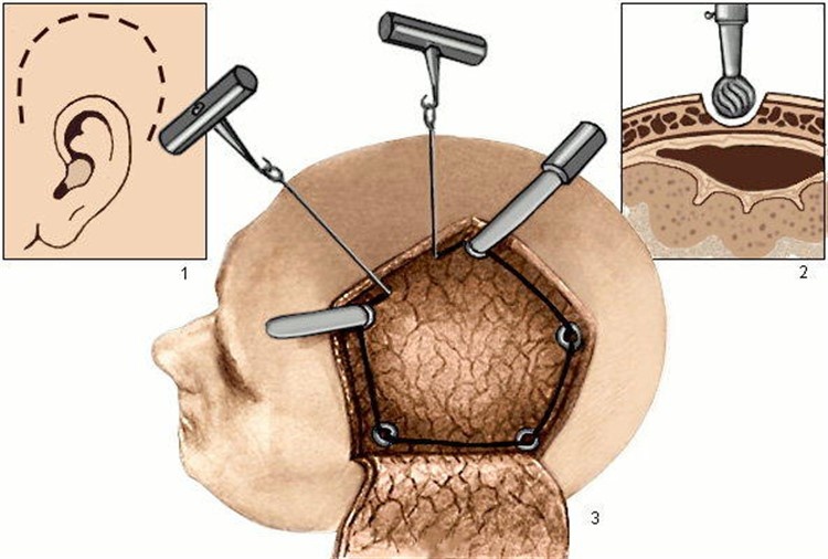 Трепанация черепа. 