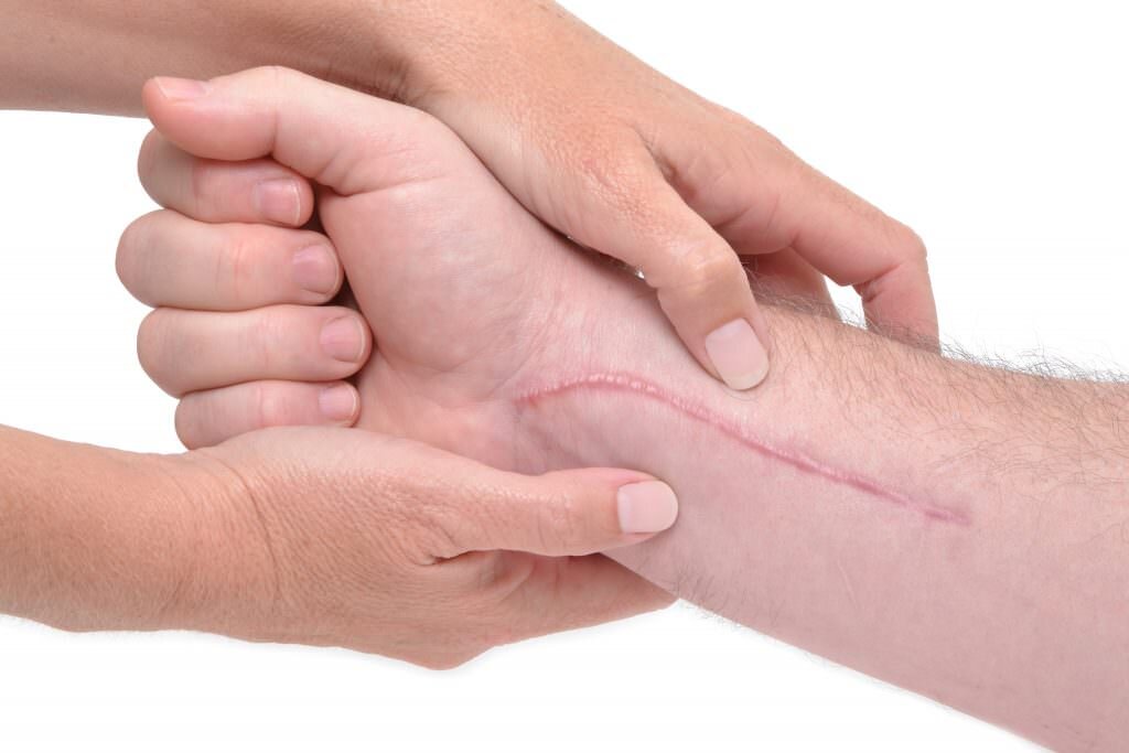 Жизнь бьет по рукам: как избавиться от шрамов после порезов? | HelperSkin |  Дзен