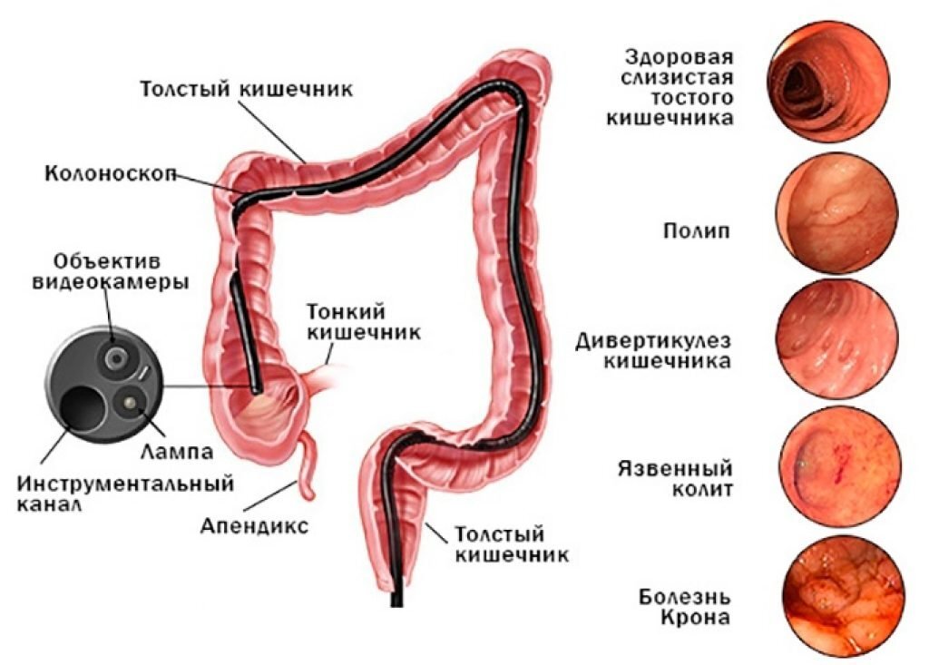 Подготовка к КТ кишечника