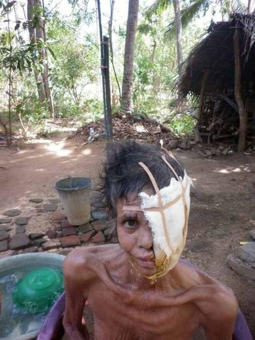  Некротический фасциит 