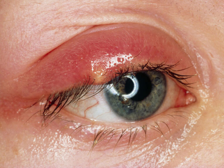 Ячмень на глазу: симптомы, лечение и профилактика