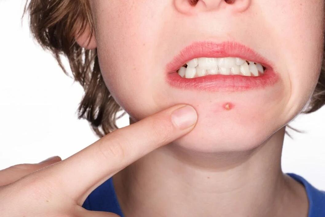 Как правильно выдавить прыщ