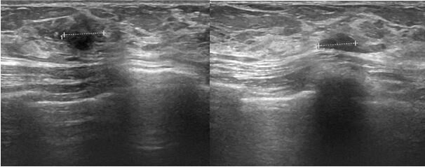 Гипоэхогенное образование в молочной железе