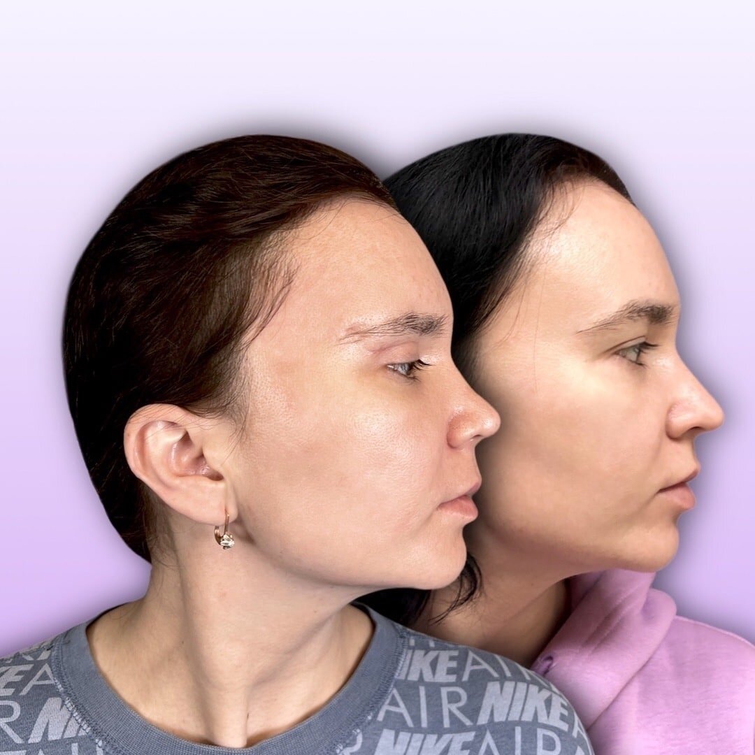 Моя пациентка после ринопластики и до операции.