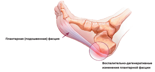 Лечение плантарного фасциита (пяточной шпоры)