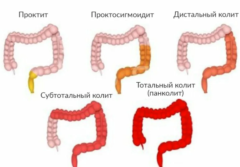 Колит кишечника - лечение, симптомы, причины