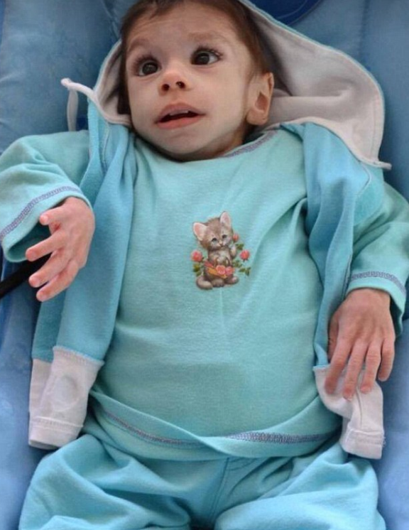 Ребенок тощ. Стройный мальчик 5 лет. Прогерия (синдром хатчинсона–гилфорда). Фотографии очень худых детей. 7-летняя ашанти элиотт-смит.