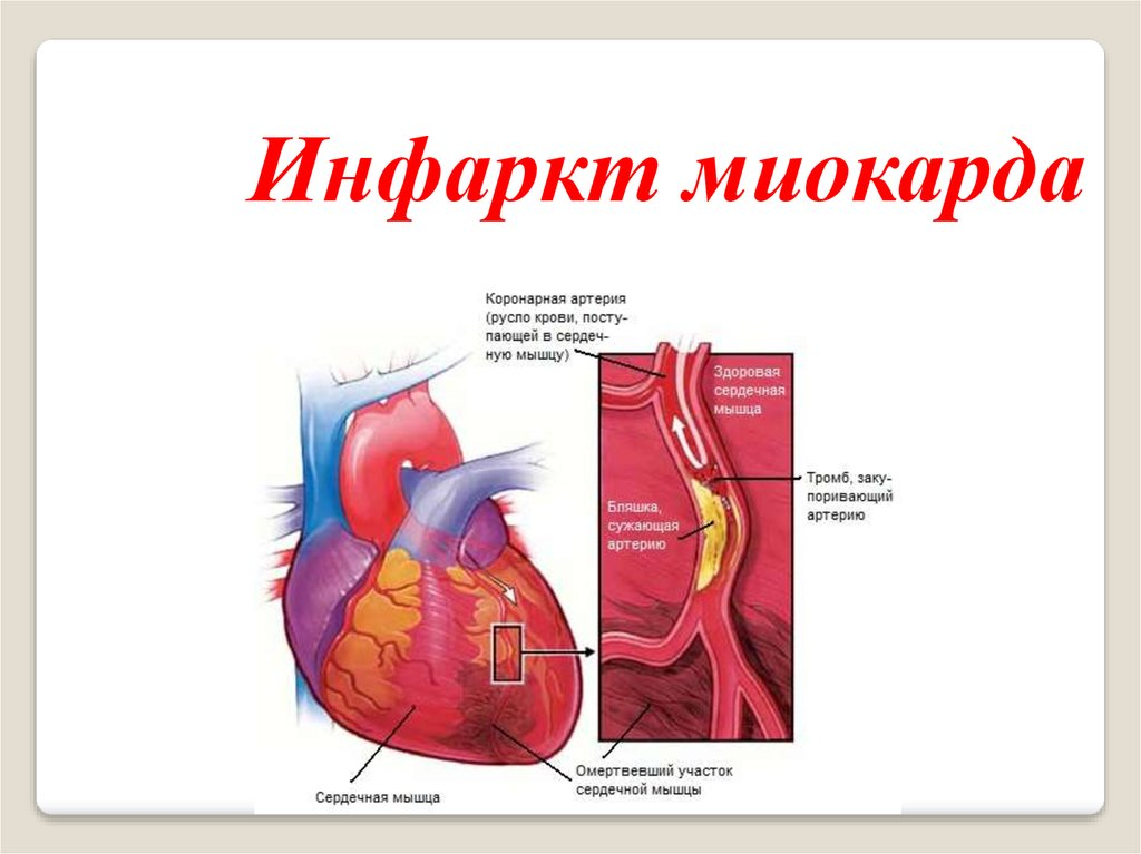 Оим. Презентация на тему инфаркт. Презентация на тему инфаркт миокарда.