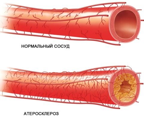  Чеснок помогает избавляться от холестериновых бляшек
