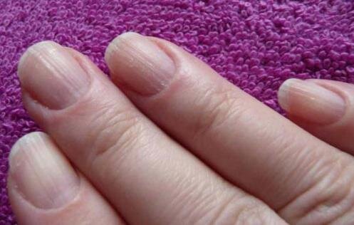 Почему ногти становятся волнистыми на пальцах рук и ног?