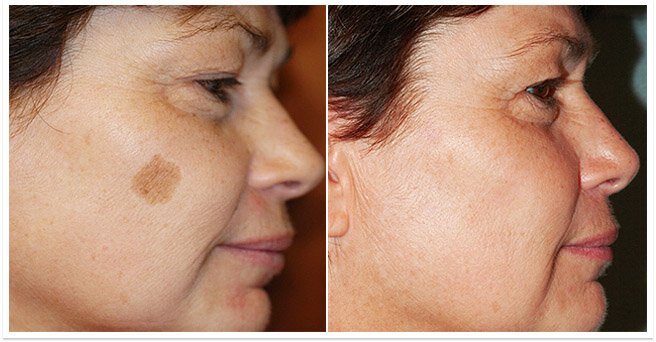  Лечение кремом  “Miracle Glow” с китайским корнем кордицепсом. Это средство основано на древнем китайском рецепте,  избавляет от веснушек, убирает сезонную и возрастную пигментацию, омолаживает кожу.                                                                                                                                                                                                                                                                                     Также в состав входят: женьшень, ангелика, даурский шафран, корневища атрактилодиса белого, ганодерма лакированная, арбутин, эфирное масло розы, даншен, а также гиалуроновая кислота, эпидермальный фактор роста, 19 видов аминокислот, витамины В12, B6, B1, B2, D, C, E и другие активные компоненты. крема убирающие пигментные пятна  
По какой причине надо заказать крем для устранения пигментации? 
• Во-первых, по цене полный курс лечения стоит меньше, чем простая процедура в косметологическом центре. 
• Во-вторых, натуральные ингридиенты в составе нежно и, главное, без вреда для здоровья отбеливают кожу, избавляют от веснушек и пигментации. 
 
Осипова Е.М., Врач-дерматолог (Опыт работы: 11 лет) 
Наибольший эффект этот крем оказывает людям старше 35 лет. Рекомендую вам побыстрее приобрести это китайское народное средство, пока крем продаётся ещё со скидкой. Древние китайские рецепты очень действенны и известны на весь Мир. 
 
Гавриленко Е.А. Врач-дерматолог (Опыт работы: более 25 лет) 
То что концентрат Cordyceps sinensis (Китайский корень Кордицепс) помогает в малые сроки устранить пигментацию, уже доказанный факт. Но буквально недавно было сделано еще одно открытие. Оказалось, что именно корень Китайского Кордицепса является замечательной профилактикой рака кожи. 
На вопрос "Реально ли избавиться от пигментации за месяц" все врачи ответили однозначно: "ДА, реально."                                                                                                                                                                                                                                                                                   Miracle Glow  
Miracle Glow - это самый мощный очиститель кожи от пигментных пятен на сегодняшний день.