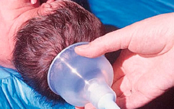 вакуум экстракция плода