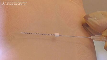 3D-нити представляют собой синтетический медицинский биоимплантат, сделанный из особого материала — полидиоксанона. Мезонити бывают разной длины и формы. Различают: