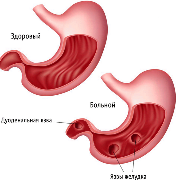 Лечение язвы желудка народными средствами | internat-mednogorsk.ru | Дзен