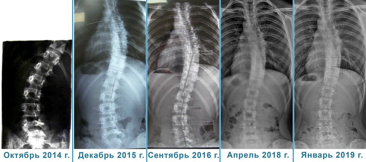 берут ли с искривлением позвоночника