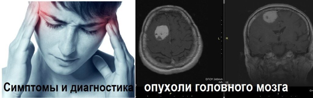 Опухоль мозга симптомы на ранней стадии. Люди с дисциркуляторная энцефалопатия. Дисциркуляторная энцефалопатия глазное дно. Дисциркуляторная энцефалопатия и курение.