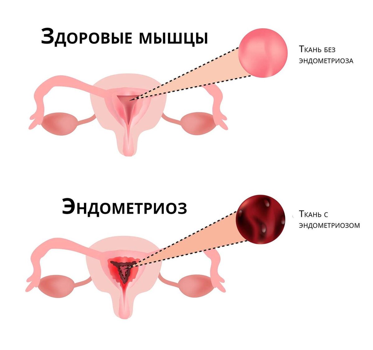 Эндометриоз. Лечение.