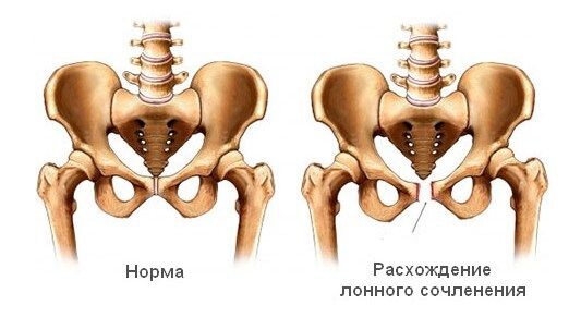 Распознать повреждение можно по характерной боли в области лобка, что усиливается при ходьбе. Лобок припухает и краснеет.
