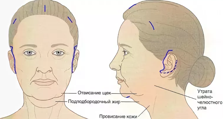 Нижняя треть шеи. Круговая подтяжка лица схема. Брыли схема. Брыли на лице схема.