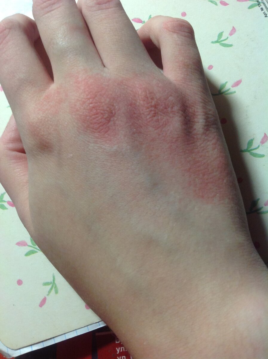 В этой статье я расскажу как избавиться от цыпок быстро и безопасно.