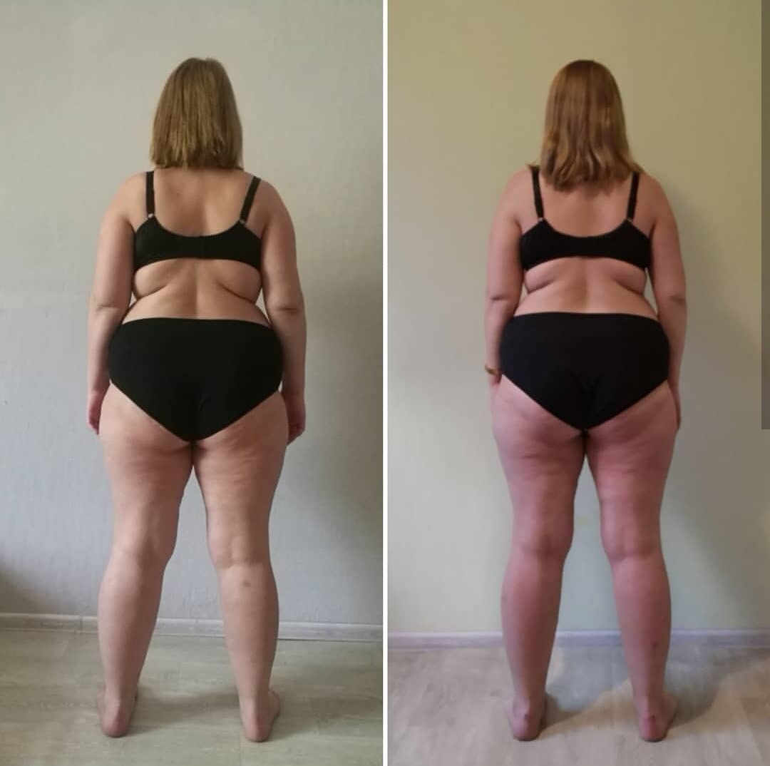Живот до и после похудения